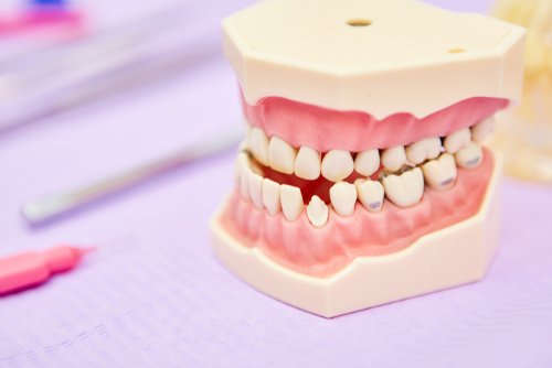 Fixing a Bad Bite: How Malocclusion Triggers TMJ Disorders