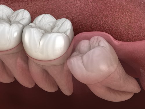 Wisdom Teeth
